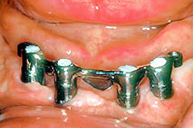 Denture Bar Secured to Denture Abutments Image of denture bar secured to denture abutments