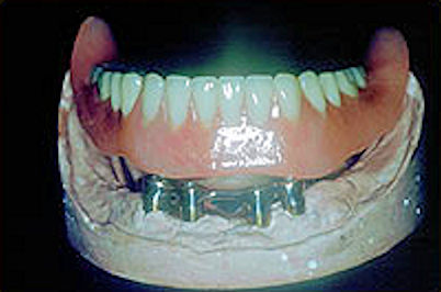 Implant Denture Seated on Implant Bar Image of seated denture implant
