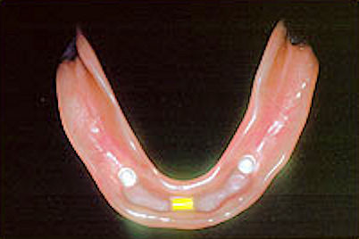 Inside of Implantable Denture Image of denture implant showing clip