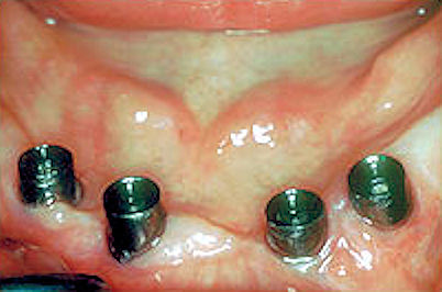 Standard Denture Abutments Image of standard abutments connected to the tops of the implants